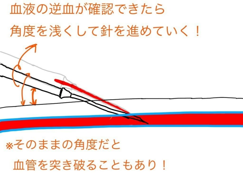 【失敗しない】点滴下手な看護師が93.5成功する点滴10つの手順 【失敗しない】点滴下手な看護師が93.5成功する点滴10つの手順