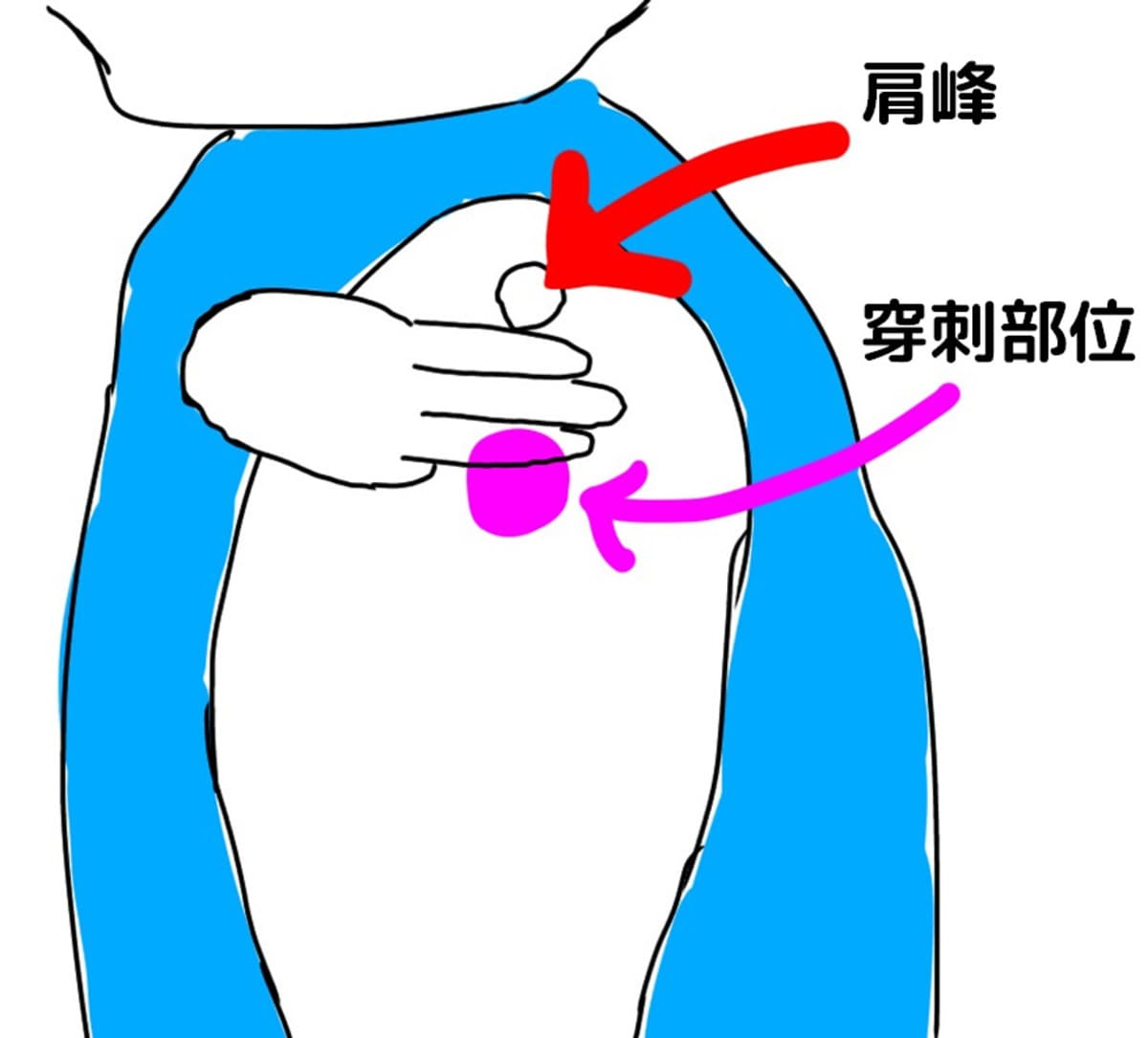 肩の筋肉注射の穿刺部位を確認～三角筋は肩峰から3横指下～